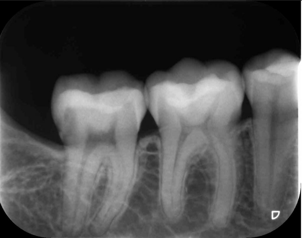 Radiografía periapical Clínica Dental Sonrie